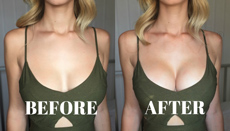 Stella showing her Upbra before and after